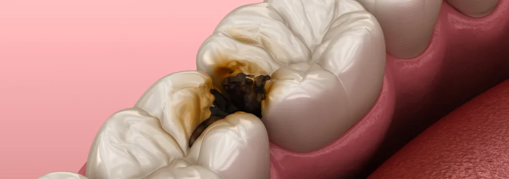 むし歯治療