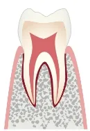 CO 初期のむし歯