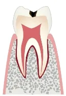 C1 エナメル質のむし歯