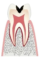 C2 象牙質のむし歯