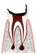 C4 歯根だけになったむし歯