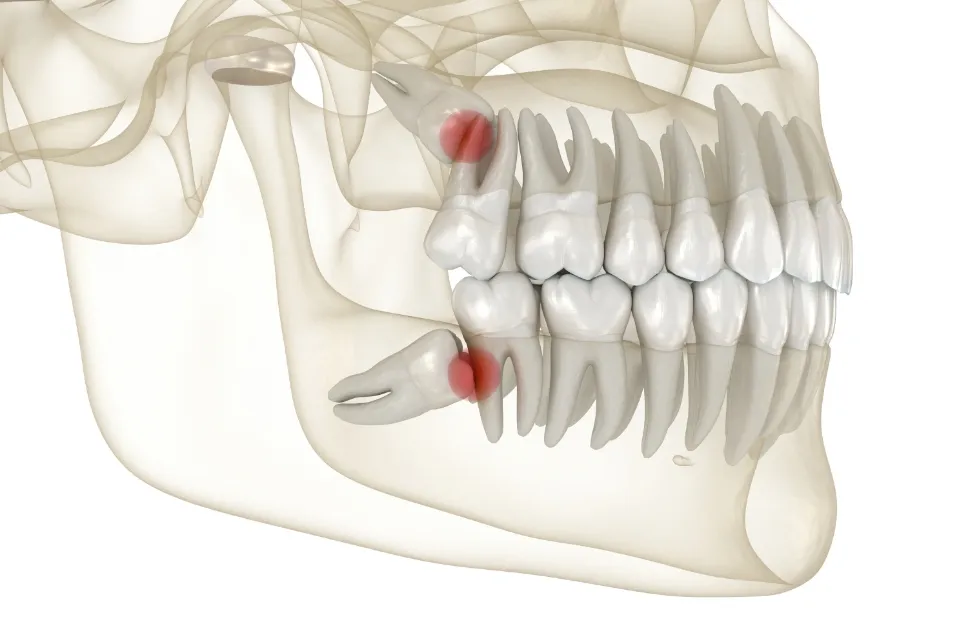 親知らずの抜歯