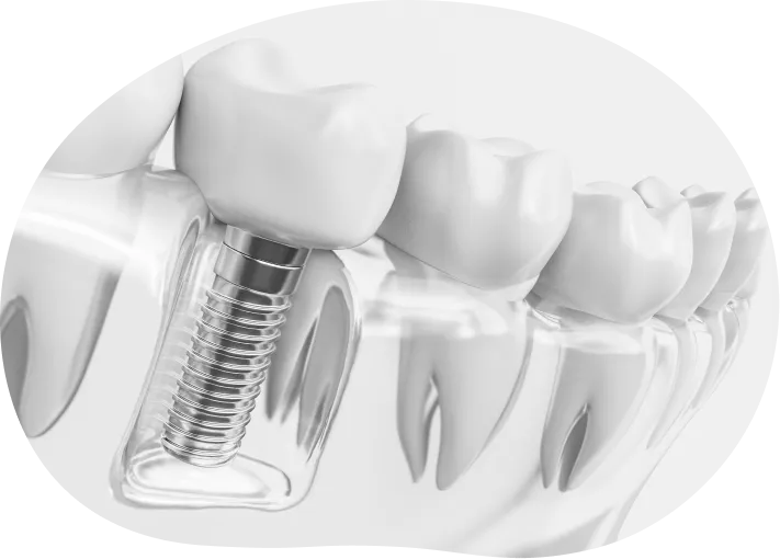 インプラント治療