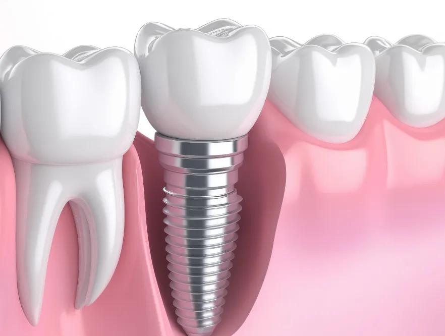 上部構造の作製・装着