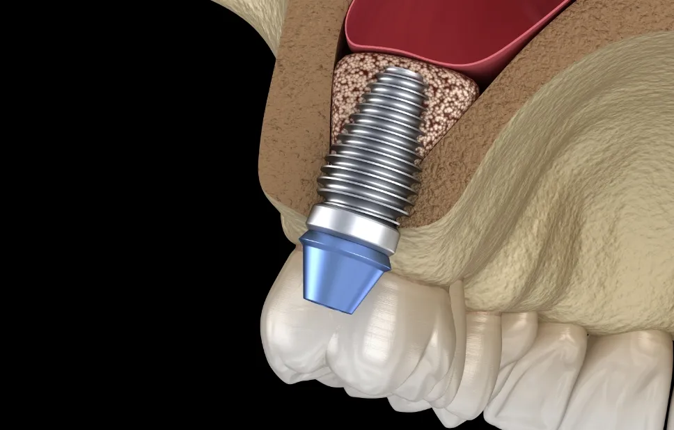 ソケットリフト