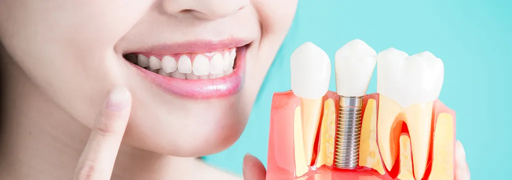 インプラントは治療後のメンテナンスが大切です