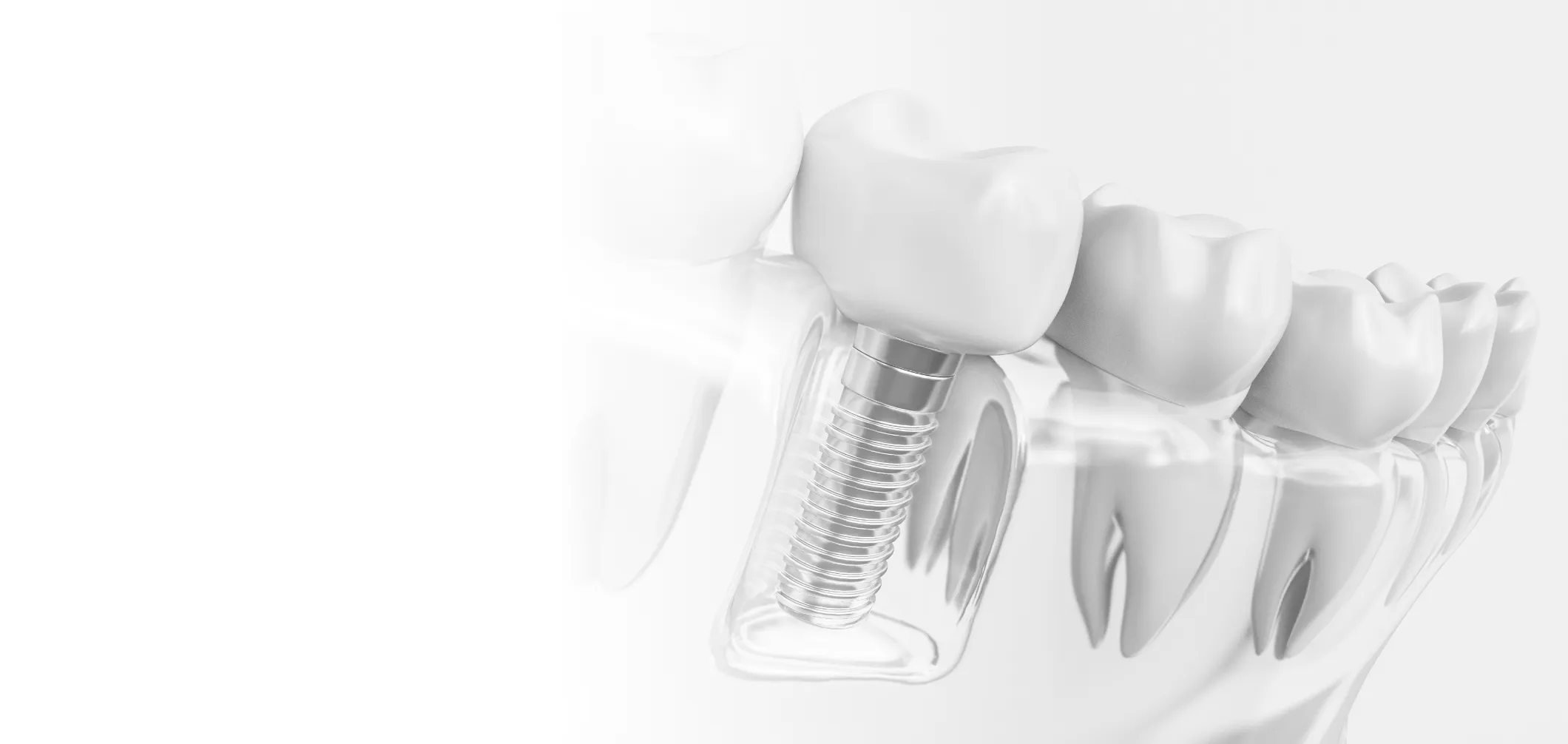 インプラント治療の不安や疑問悩むより、まずはご相談ください