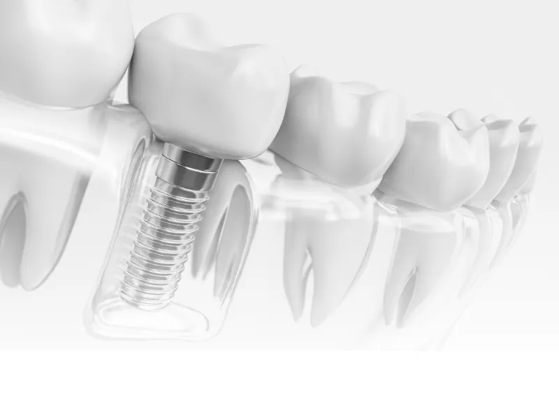 インプラント治療の不安や疑問悩むより、まずはご相談ください