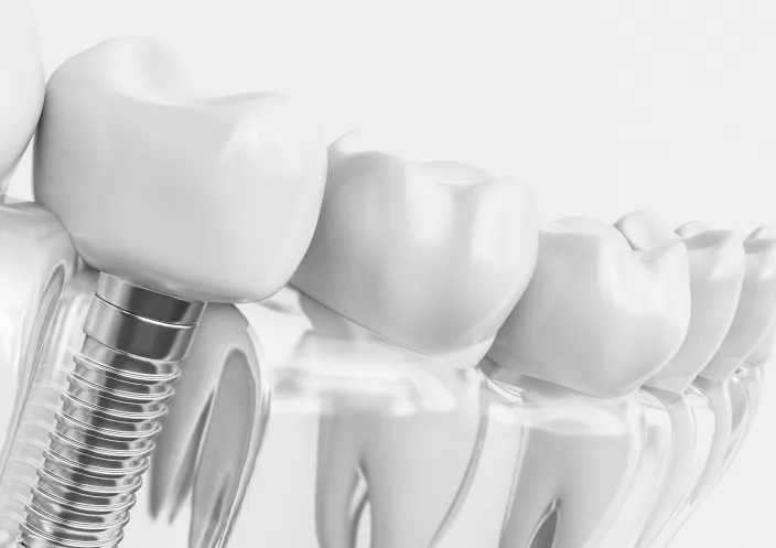 インプラント治療