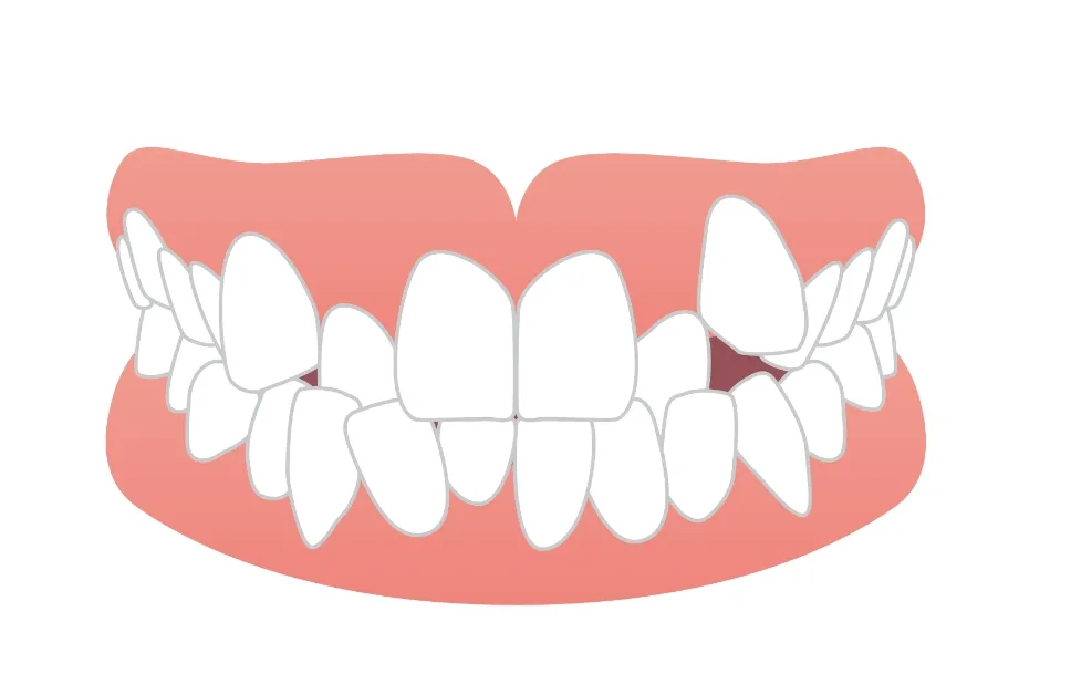 叢生（八重歯・乱ぐい歯）