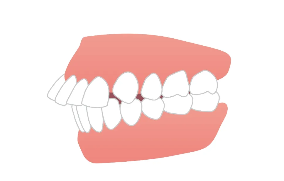 上顎前突（出っ歯）