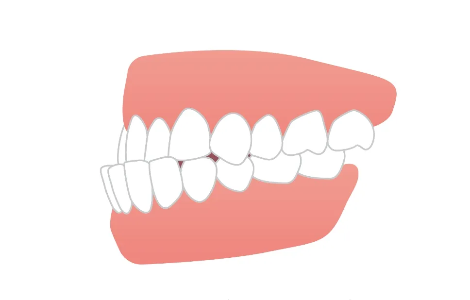下顎前突・反対咬合（受け口）