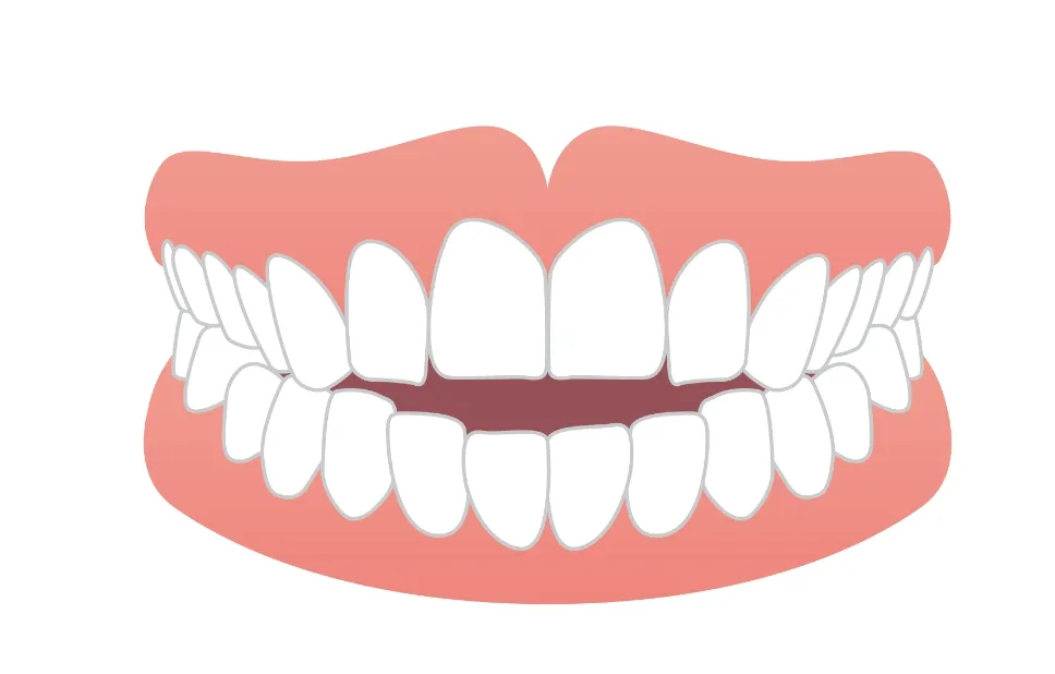 開咬・オープンバイト（前歯が閉じない）