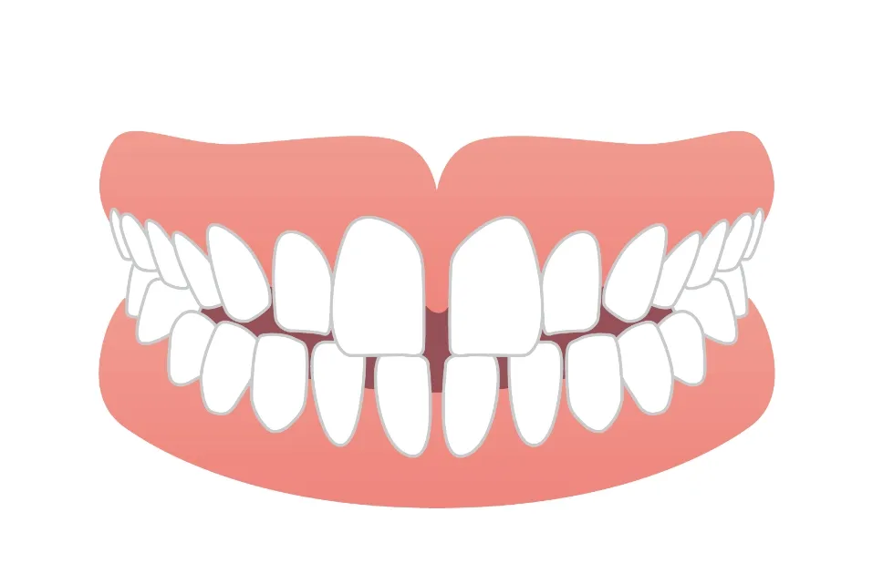 空隙（くうげき）歯列（すきっ歯）