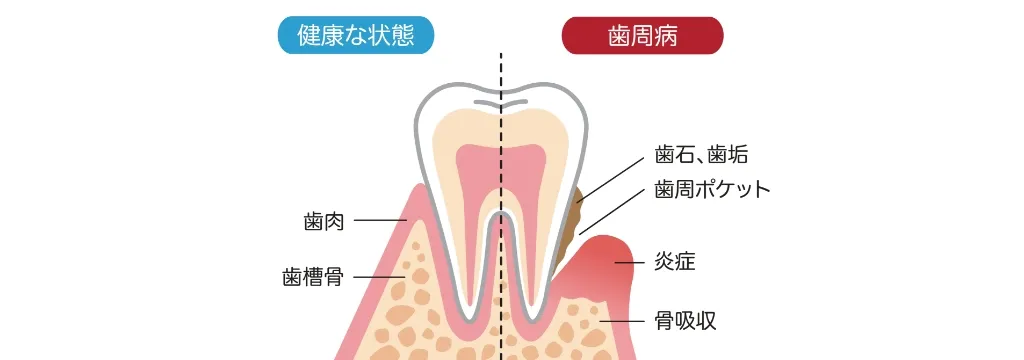 歯周病とは
