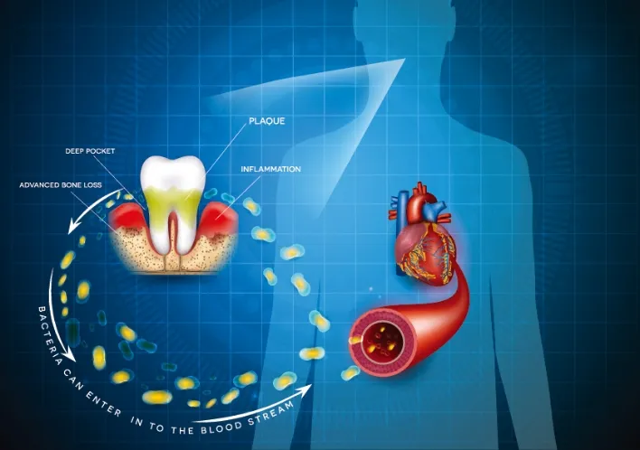 歯周病と全身疾患との関係
