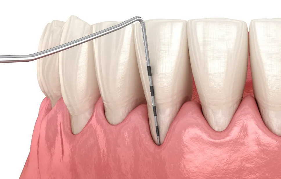 歯周検査・歯周ポケット測定