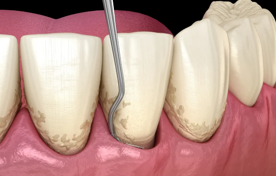 ルートプレーニング